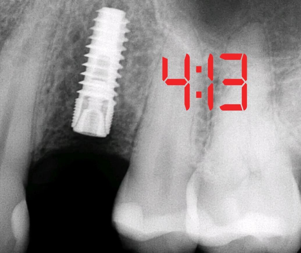 5 Minute Implants