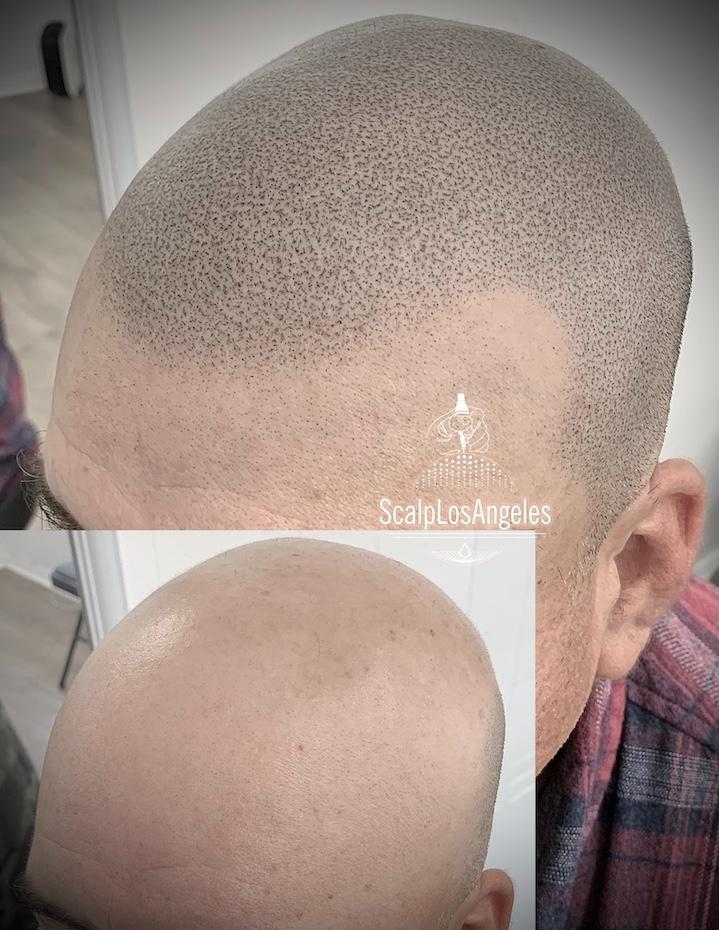 Scalp Los Angeles