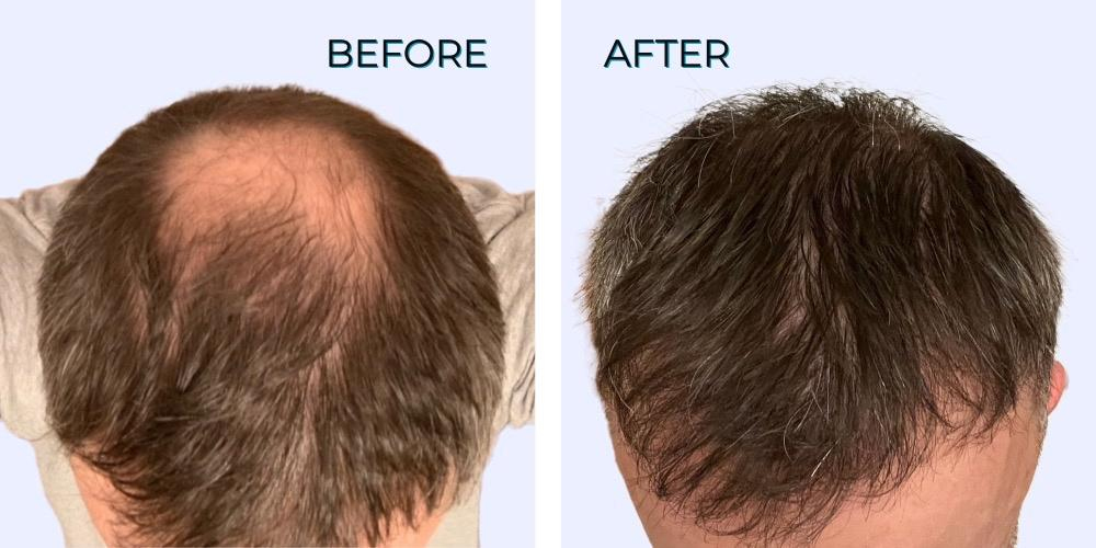 John Frank, MD Hair Clinics